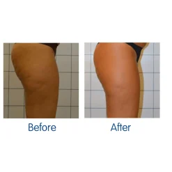 Heat in A Click LLC LED Cellulite Reducing Device