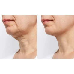 sharper image Wrinkle Reducing Neck Therapy Device